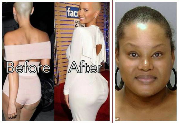 Amber Rose butt injections. 