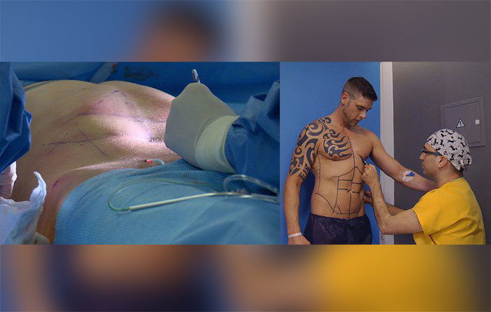 Dude travels across Europe just to have permanent six pack surgery