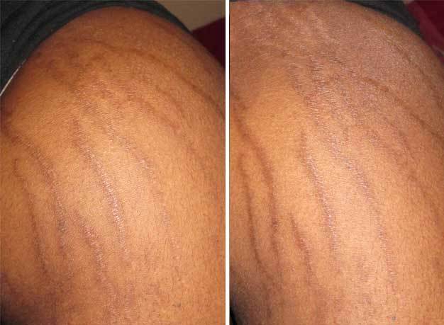 Top 10 stretch mark myths debunked