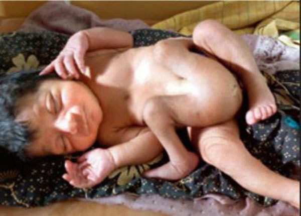 The baby who was born with four legs