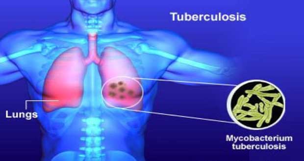 Tuberculosis paper based test discovered. 